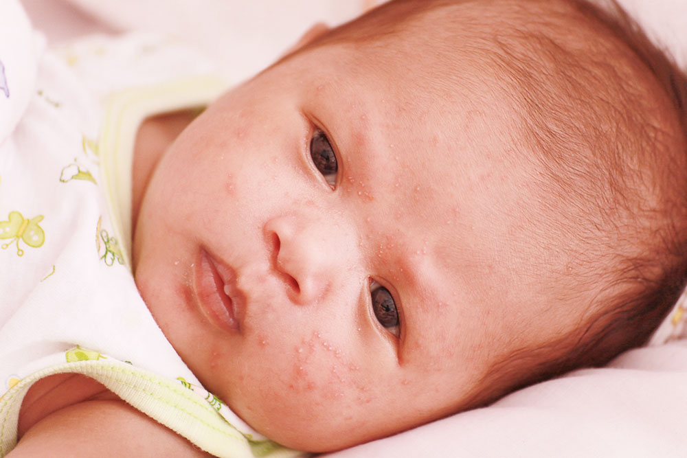Atopic dermatitis in infants – Signs and management tips